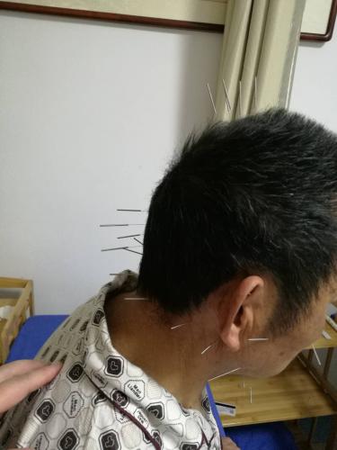 脑中风后遗症康复治疗