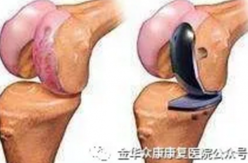 膝关节置换术适应症及何时进行术后康复