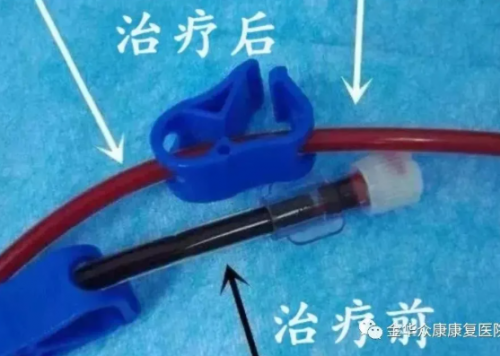 三氧自血疗法可以治疗什么疾病？